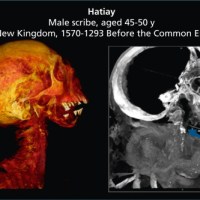 Imaging the past: Dental Pathologies and Cardiovascular Disease in Egyptian Mummified&nbsp;Remains